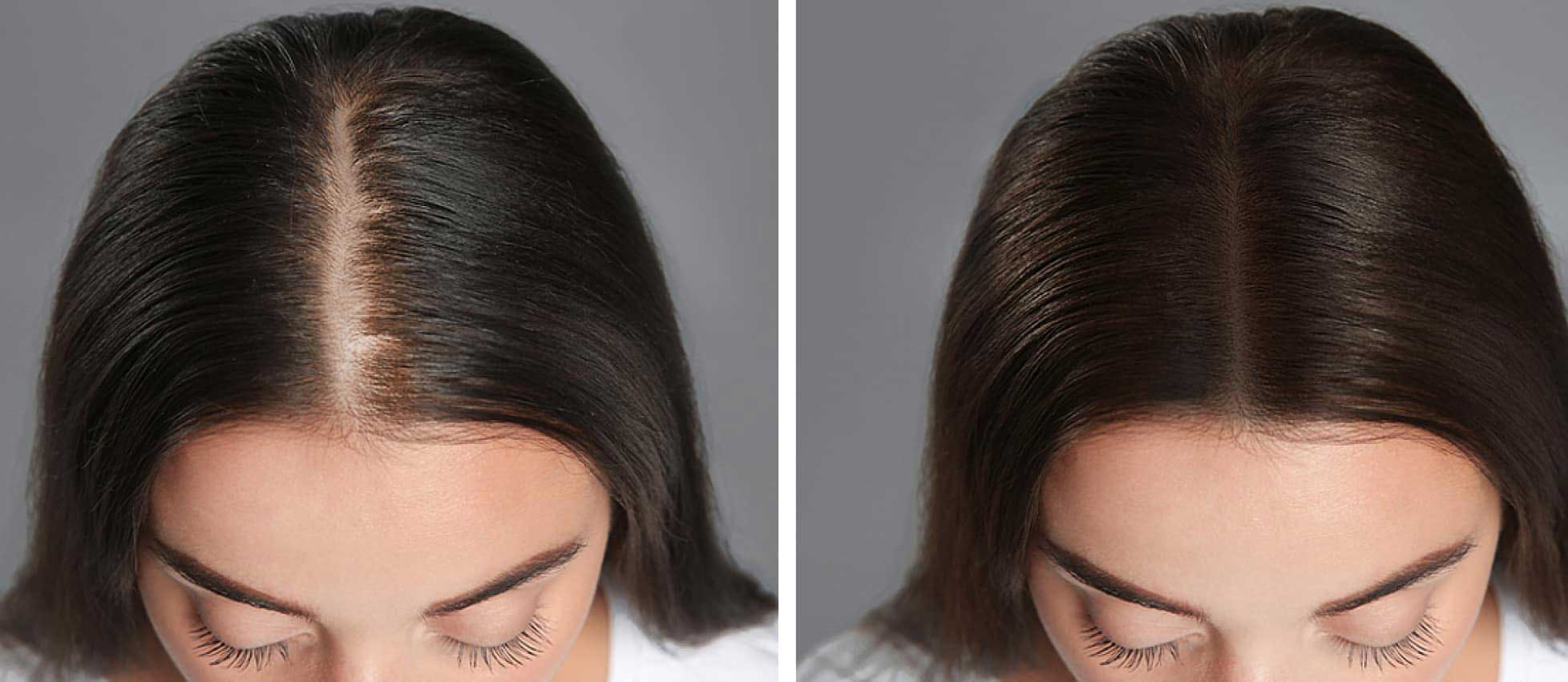 Ace of Fades 212 Non Surgical Hair Experts